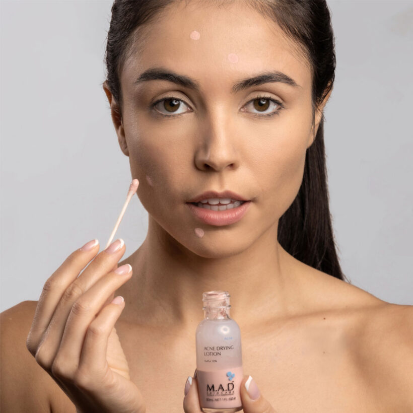 Model applying Acne Drying Lotion Sulfur 10%