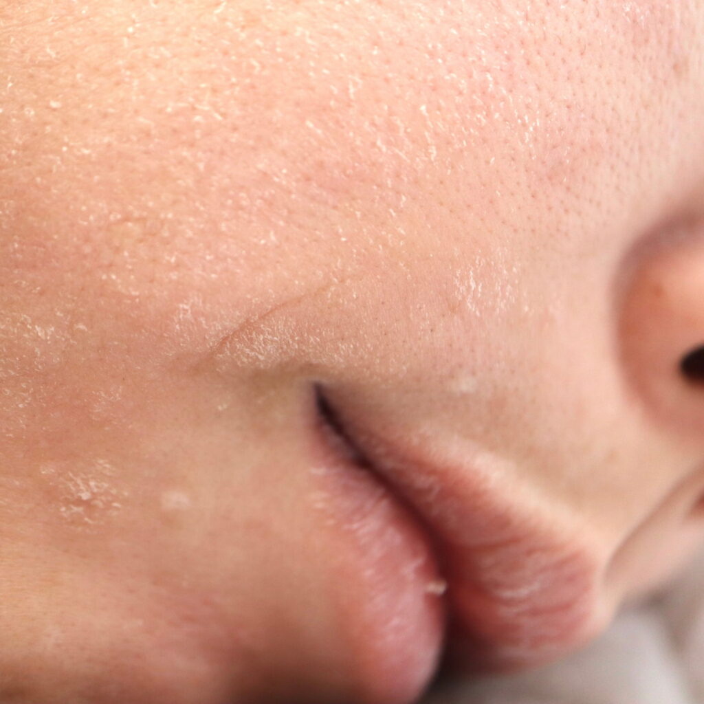 Face with Dehydrated Skin