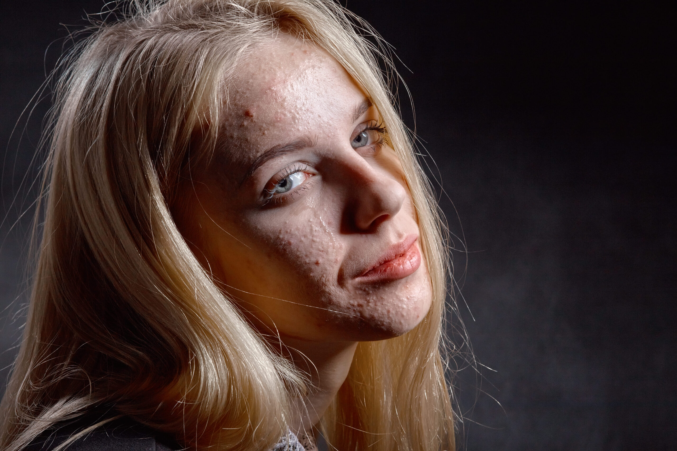 Woman having acne and dry skin