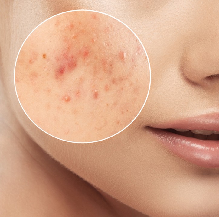 A woman having breakouts on her face