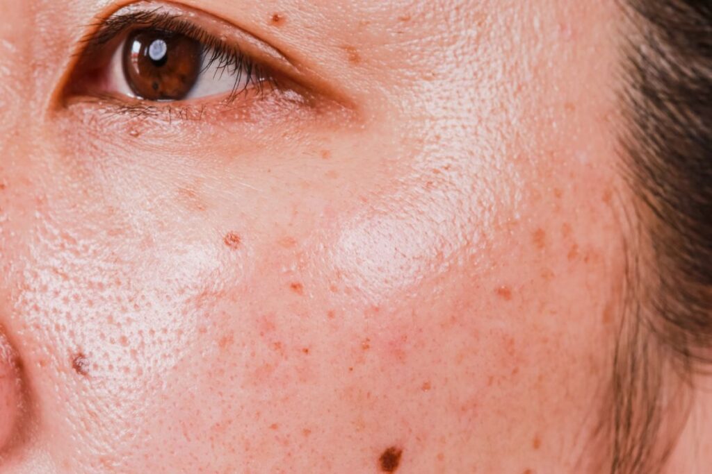 A woman having Enlarged Pores