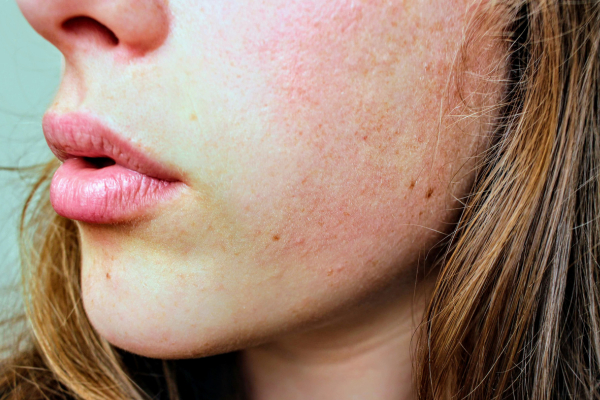 signs of a damaged skin barrier