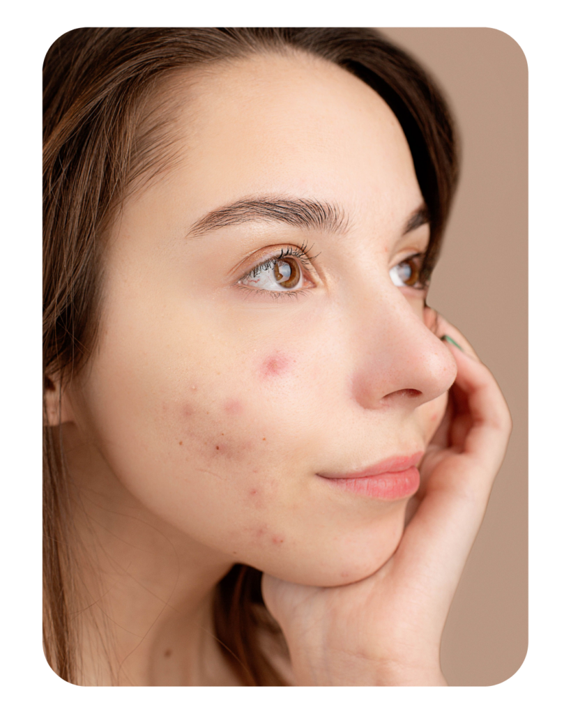 A girl having acne on her face