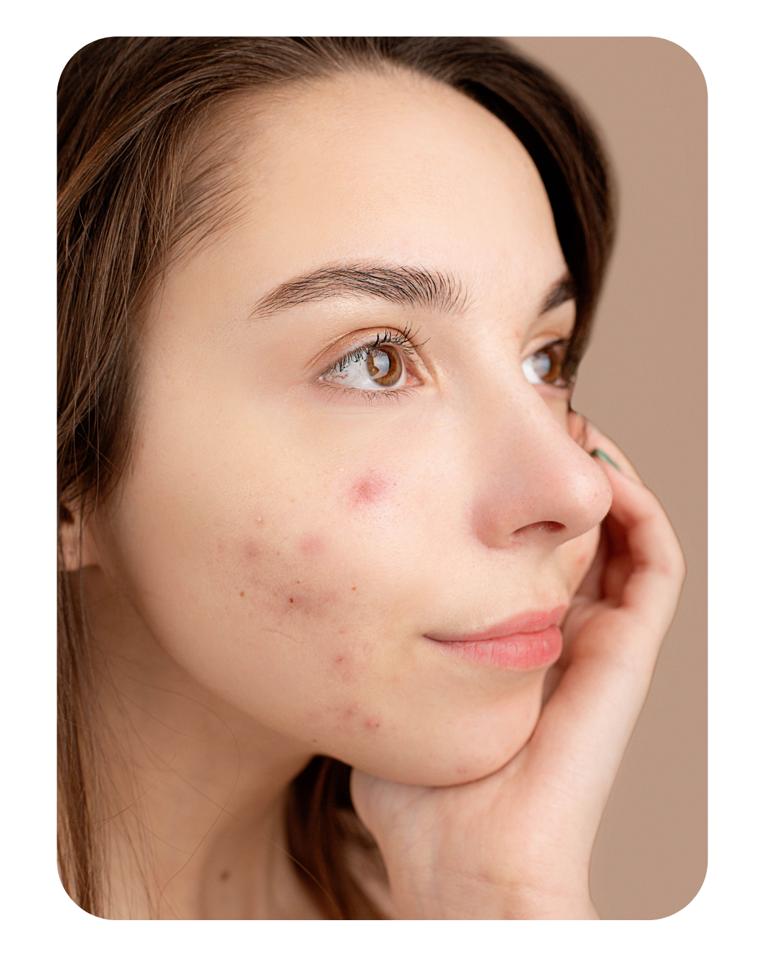 A girl having acne on her face